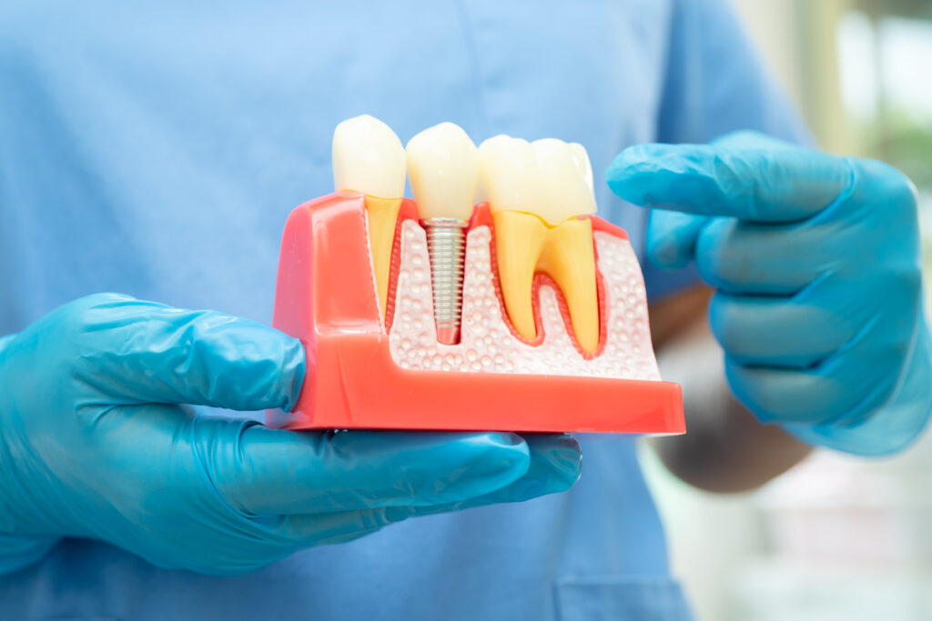 A Melrose Arch Dentist’s Life Changing Secret Behind Dental Implants, You Never Knew