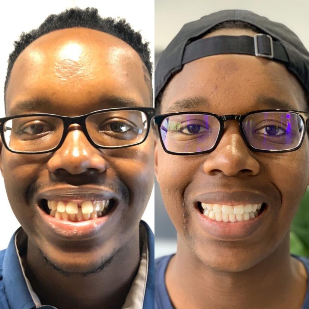 Active Aligners before and after in only 6 months