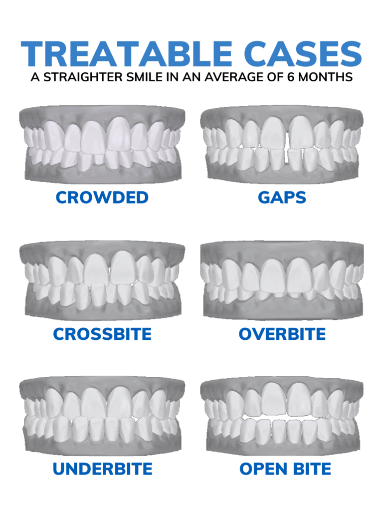 Active Aligners treatable cases - what can active aligners fix or straighten